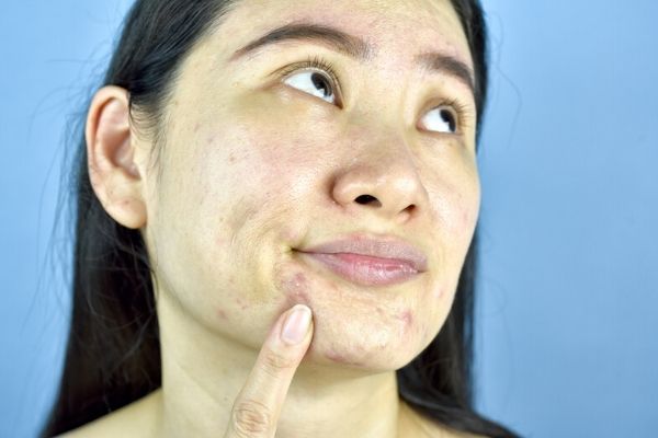woman unhappy with dirty oily skin