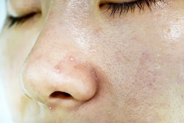 woman with oily skin type