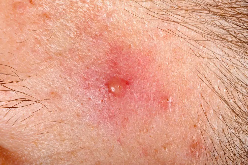 cyst is a form of inflammatory acne