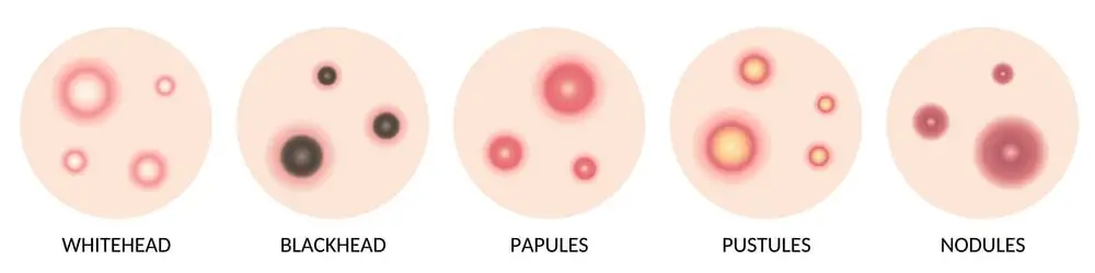 acne types on the face