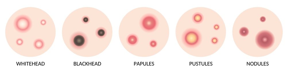 What Type Of Acne Do I Have? 6 Types of Acne Explained