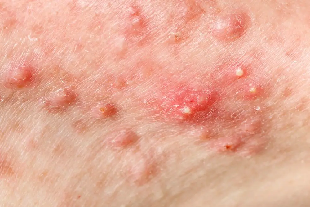 nodules is one of the type of inflammatory acne