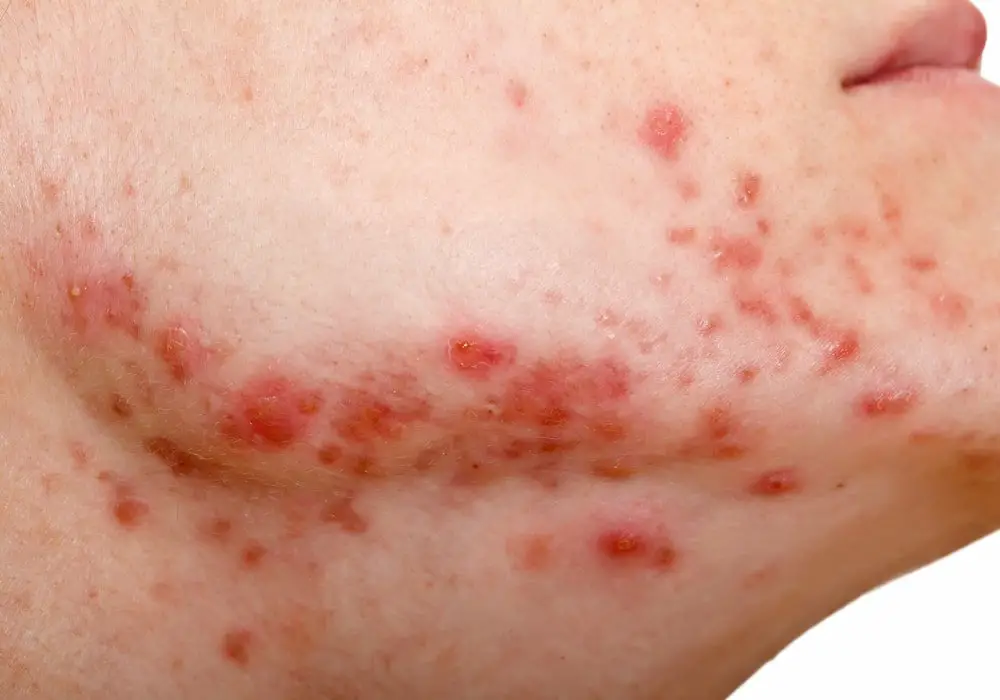 papules is one of the many forms of acne