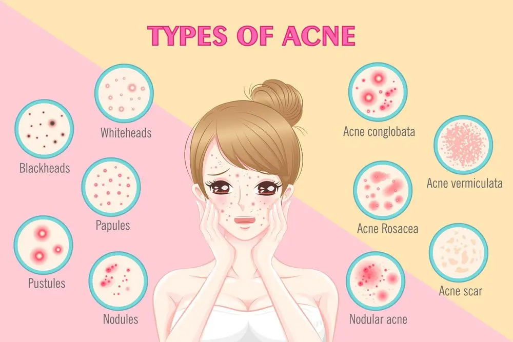 acne types