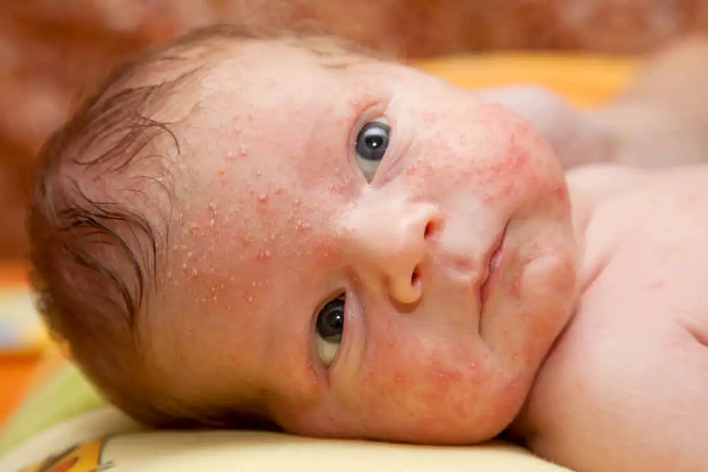 baby acne causes and treatment