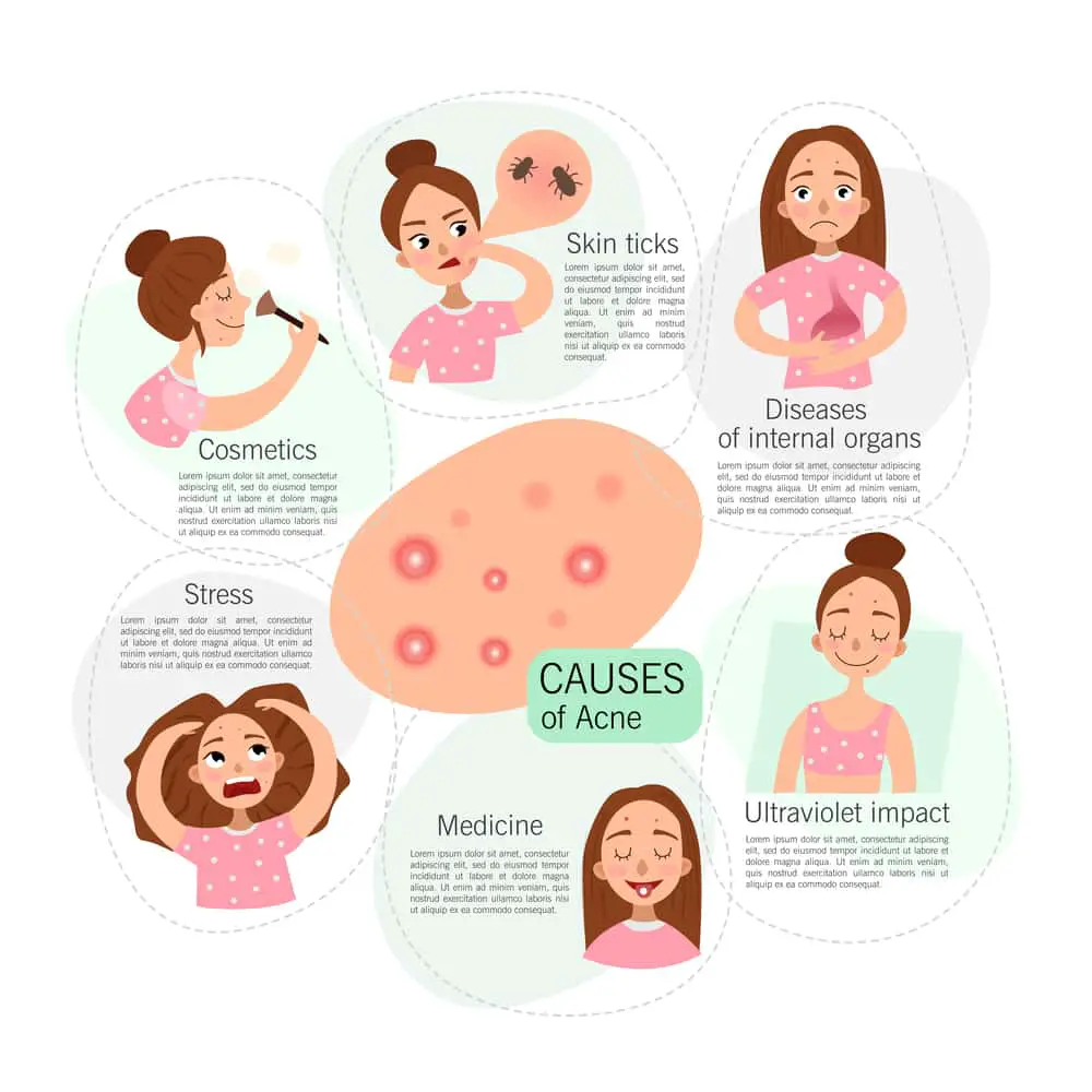 what causes acne