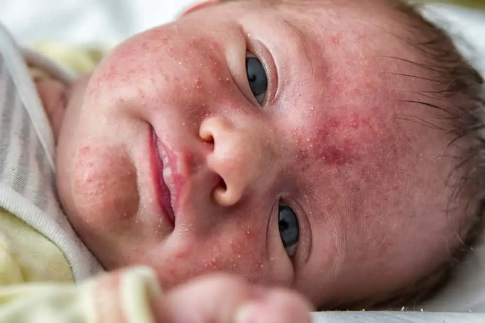 baby acne symptoms