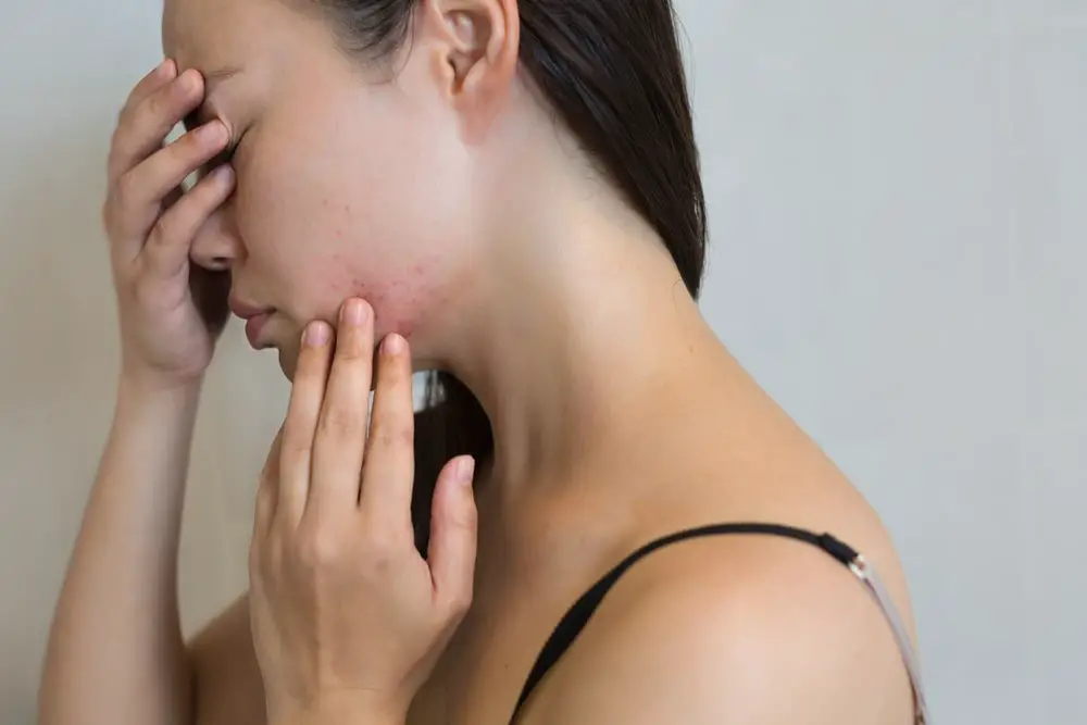 can acne pills cause depression