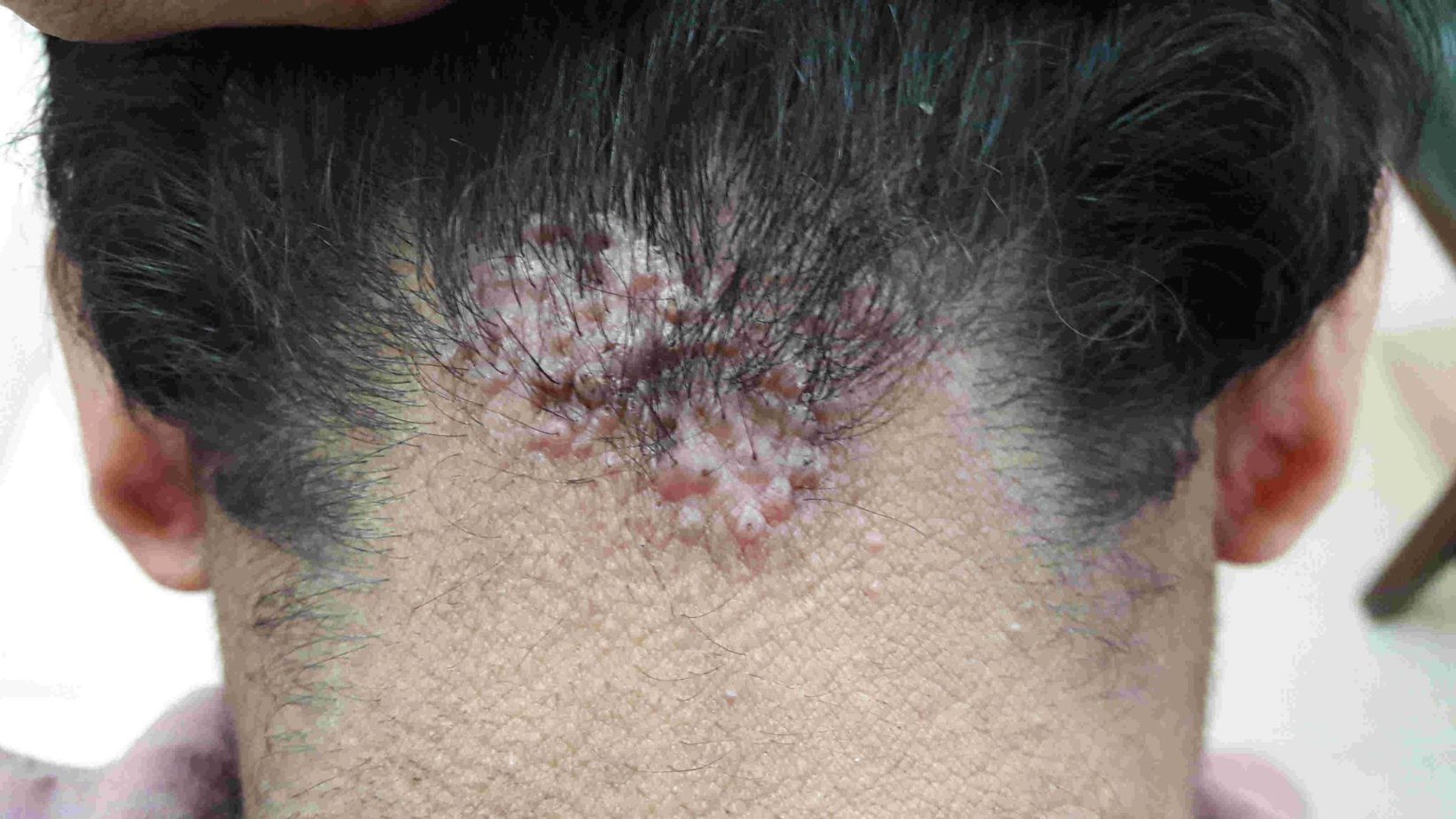 Can Acne Keloidalis Cause Hair Loss? What You Need To Know