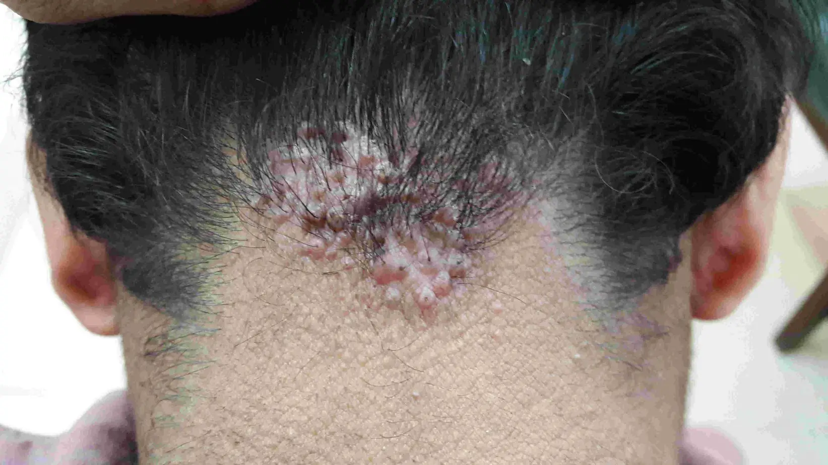 what causes acne keloidalis nuchae