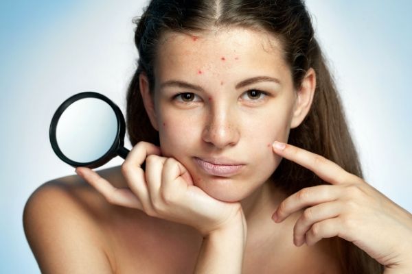can too much retinol cause acne