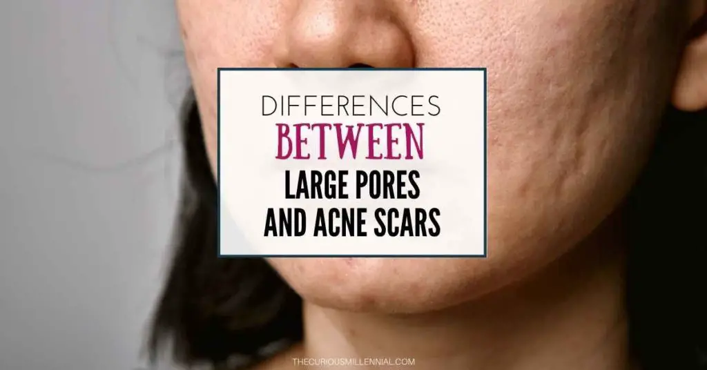 what-is-the-difference-between-acne-scars-and-large-pores