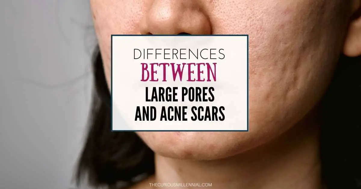 acne scars and large pores