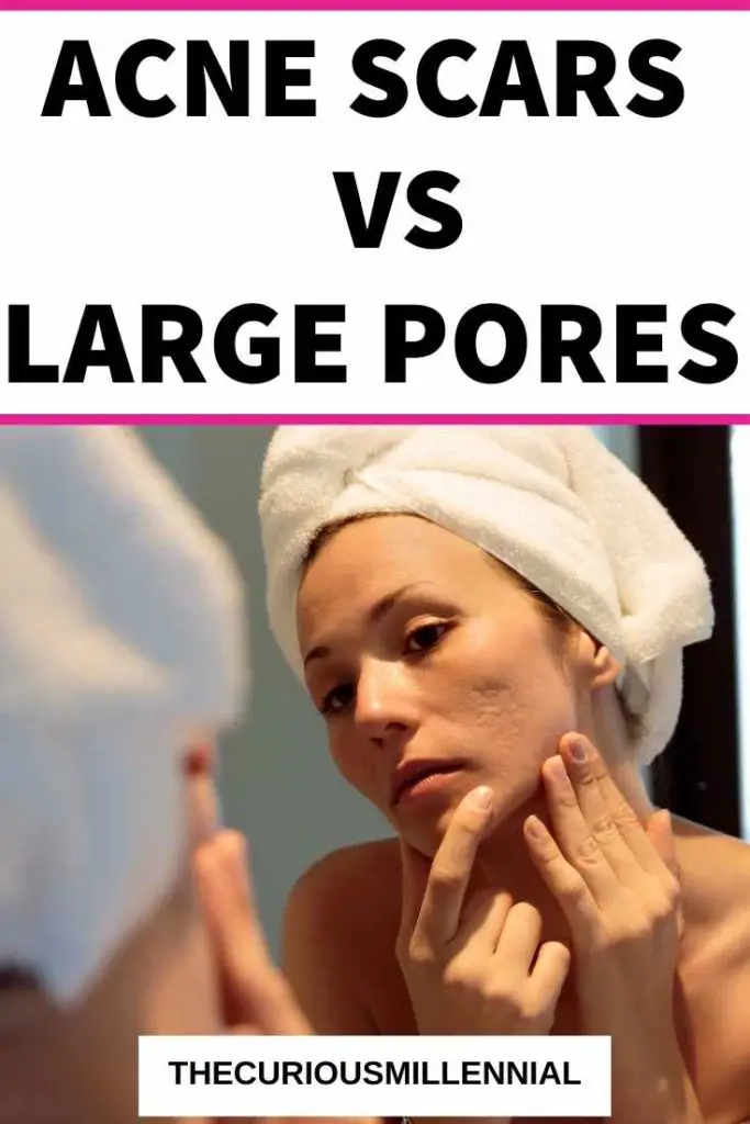 differences between acne scars and large pores